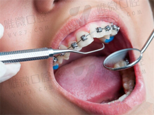 修复种植牙齿（种植牙后悔一辈子）(图1)